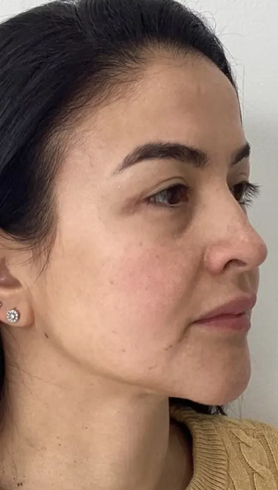 Before — HIFU Full Face & Neck