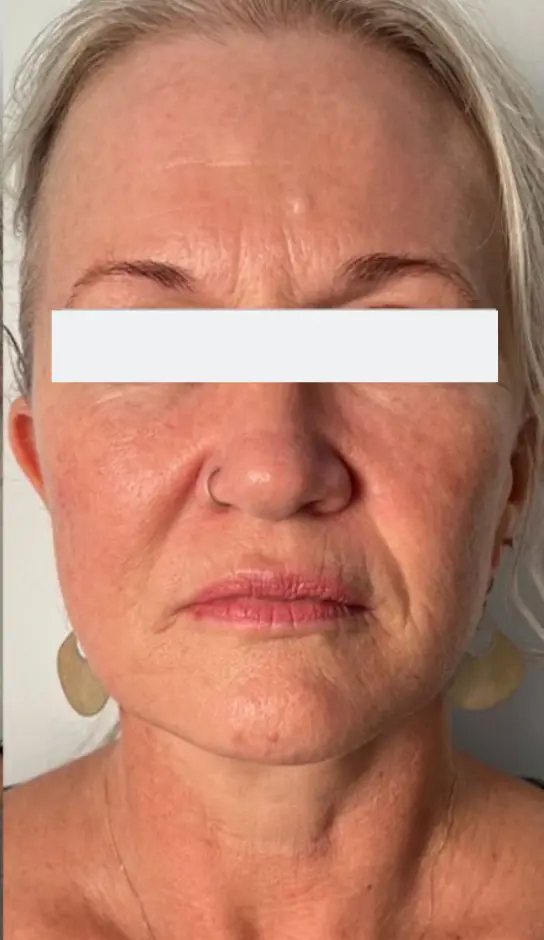 After — HIFU Full Face & Neck