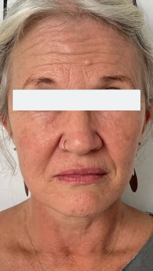 Before — HIFU Full Face & Neck
