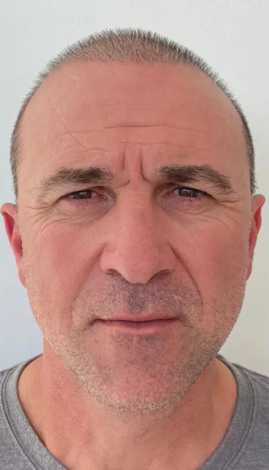Before — HIFU Full Face & Neck