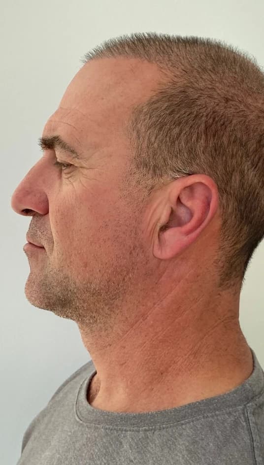 Before — HIFU Full Face & Neck