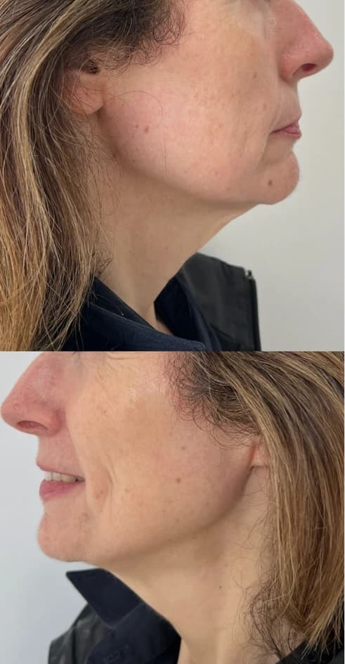 After — HIFU Full Face & Neck