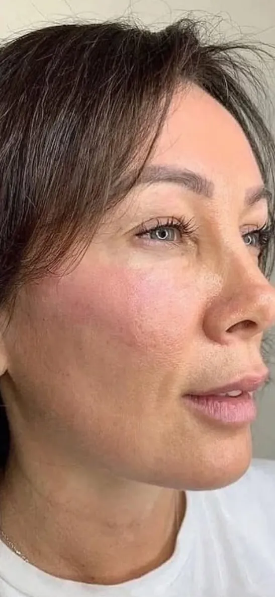 After — HIFU Full Face & Neck
