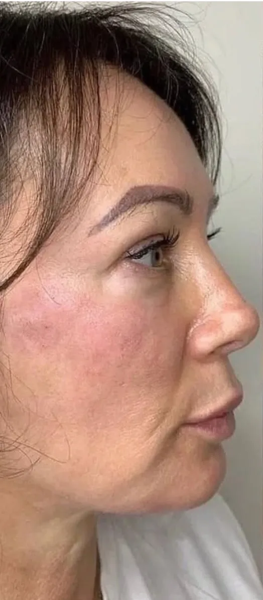 Before — HIFU Full Face & Neck
