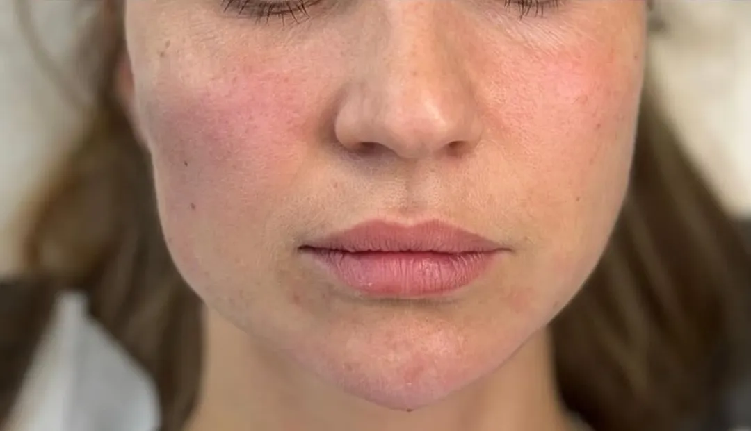 After — HIFU Full Face & Neck