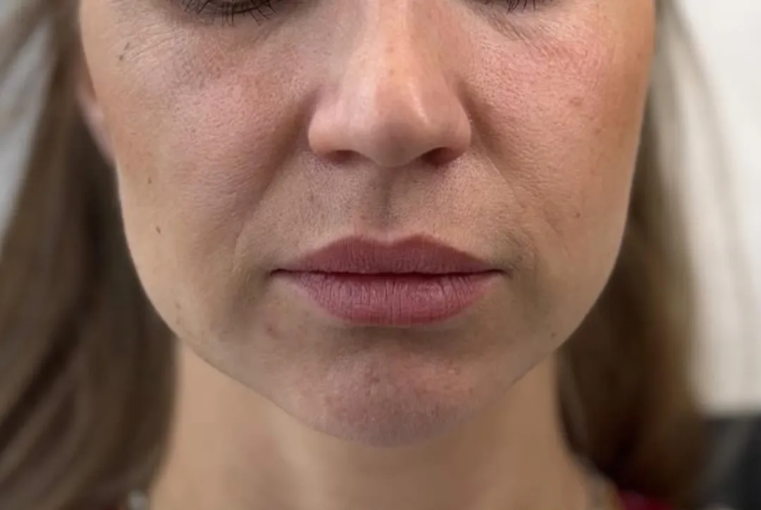 Before — HIFU Full Face & Neck
