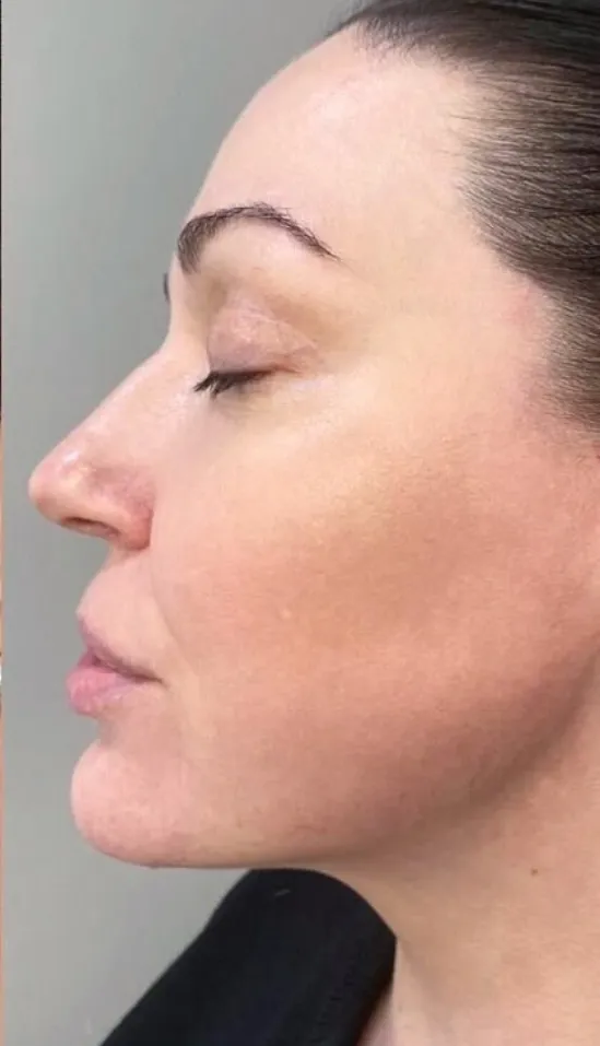 After — HIFU Full Face & Neck