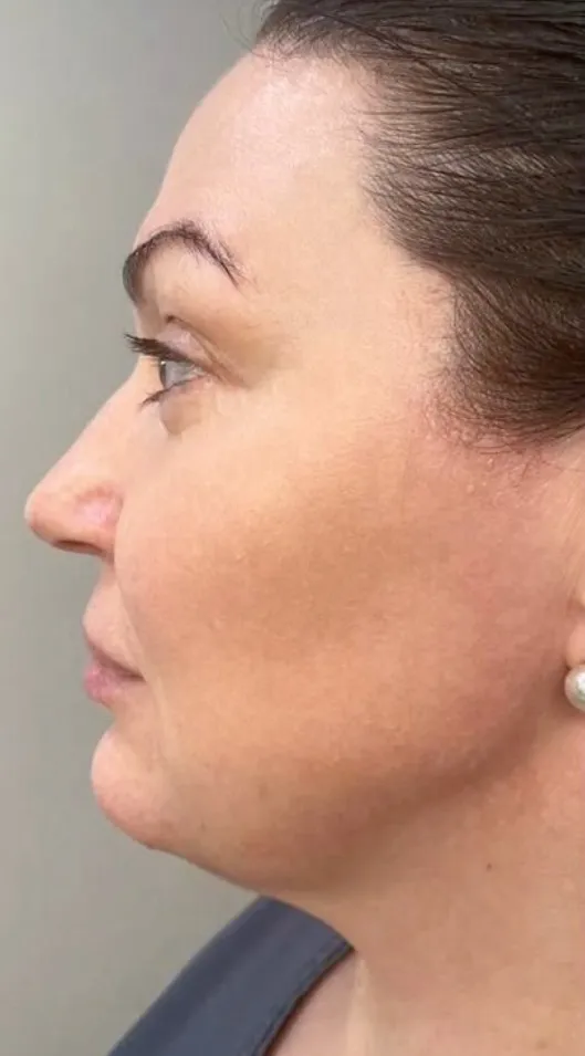 Before — HIFU Full Face & Neck
