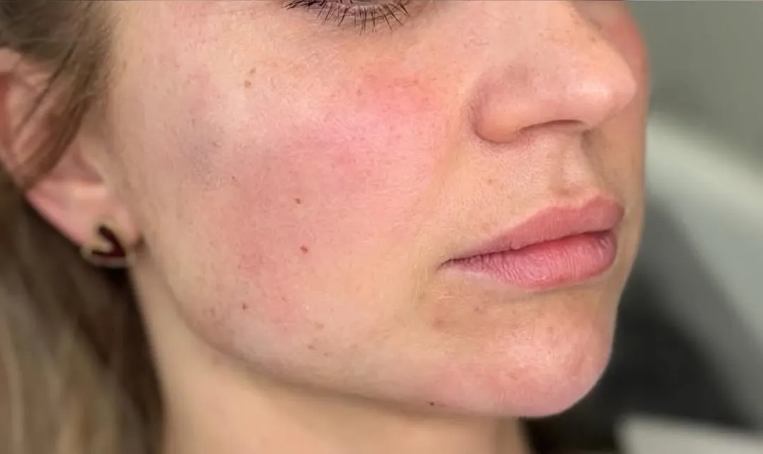 After — HIFU Full Face & Neck