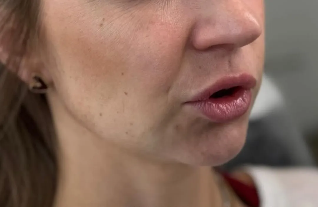 Before — HIFU Full Face & Neck