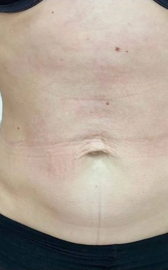 After — HIFU Abdomen