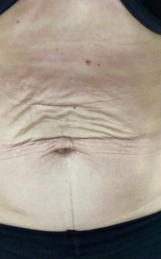 Before — HIFU Abdomen