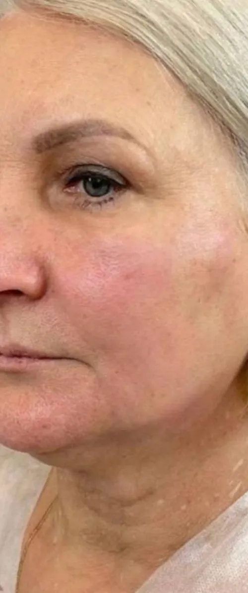 After — HIFU Full Face & Neck