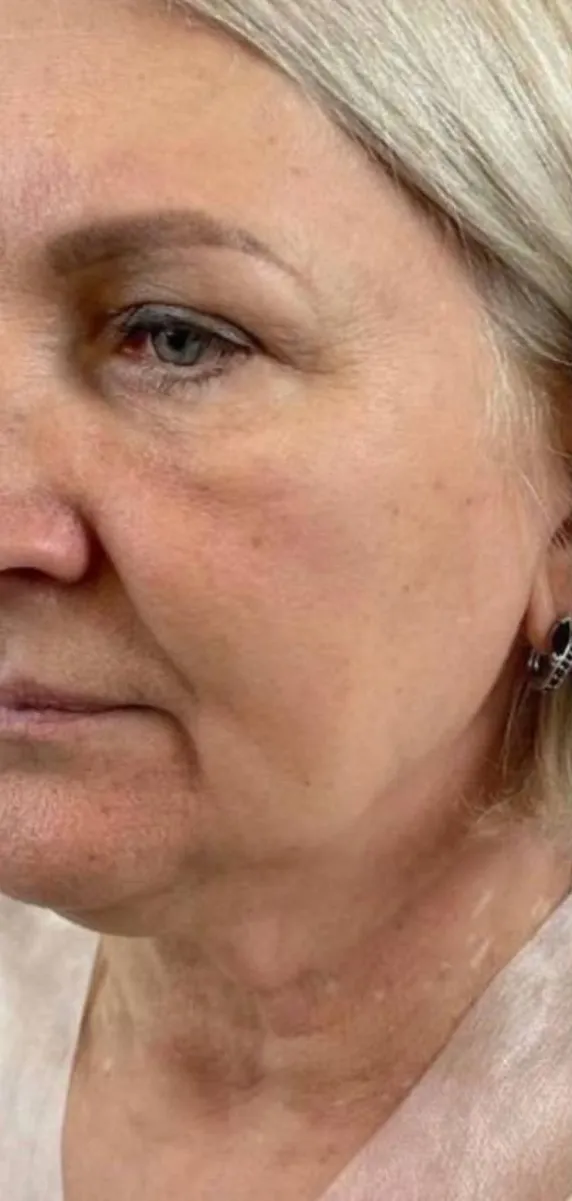 Before — HIFU Full Face & Neck