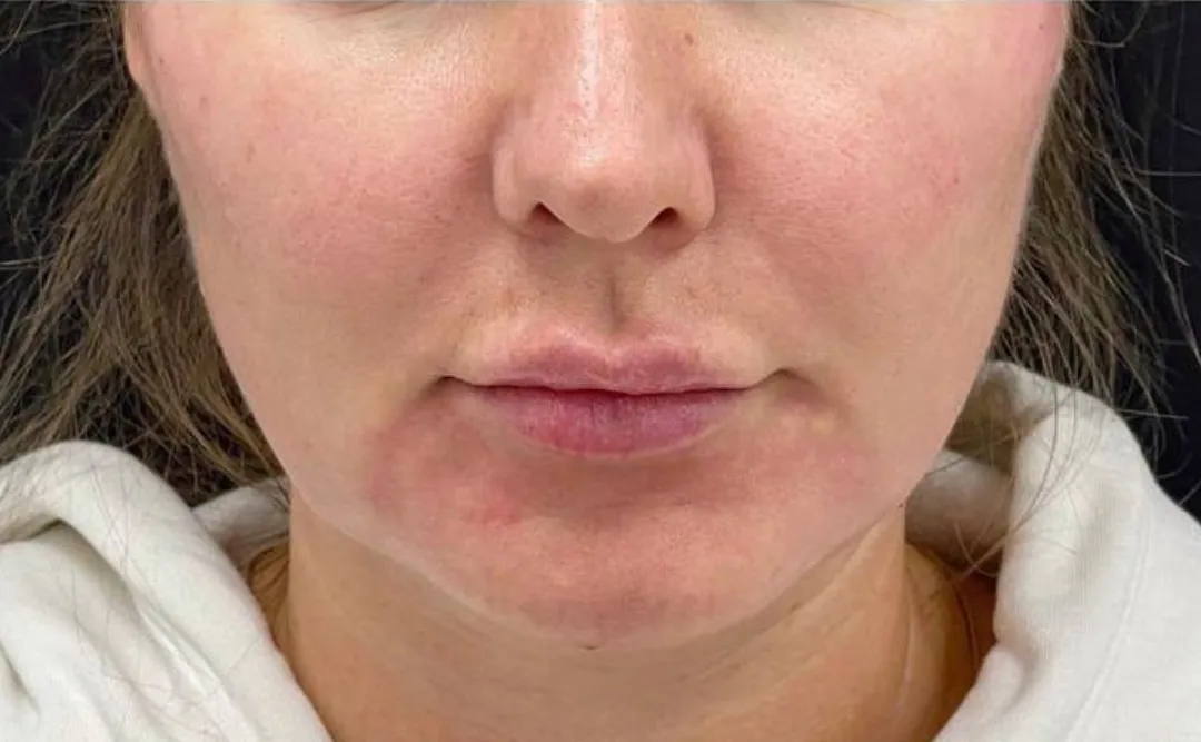 After — HIFU Full Face & Neck