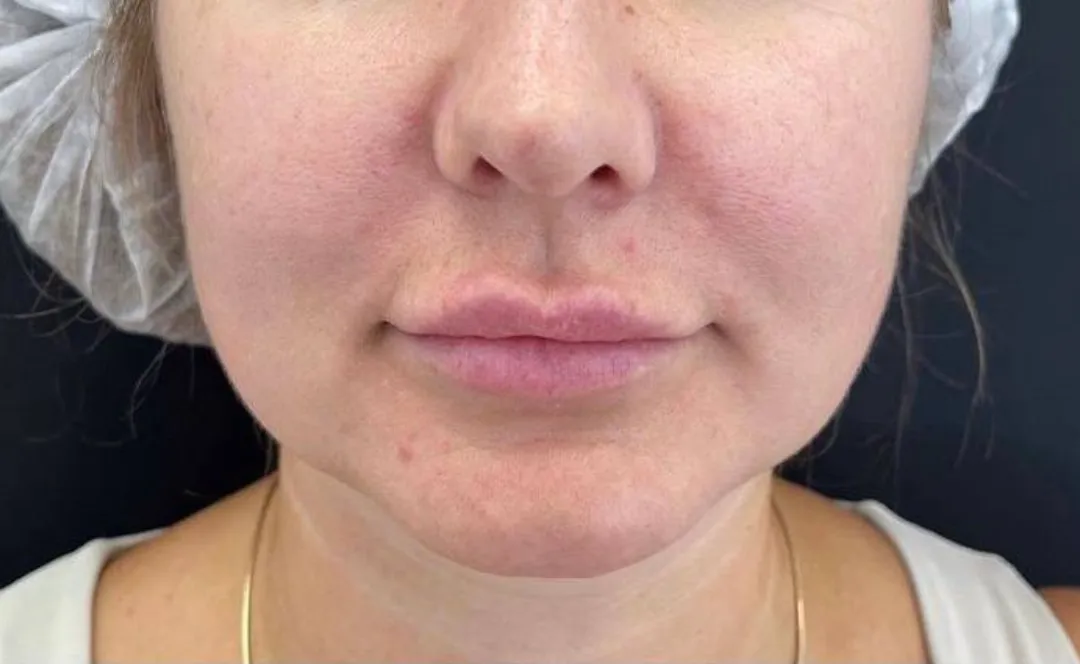 Before — HIFU Full Face & Neck