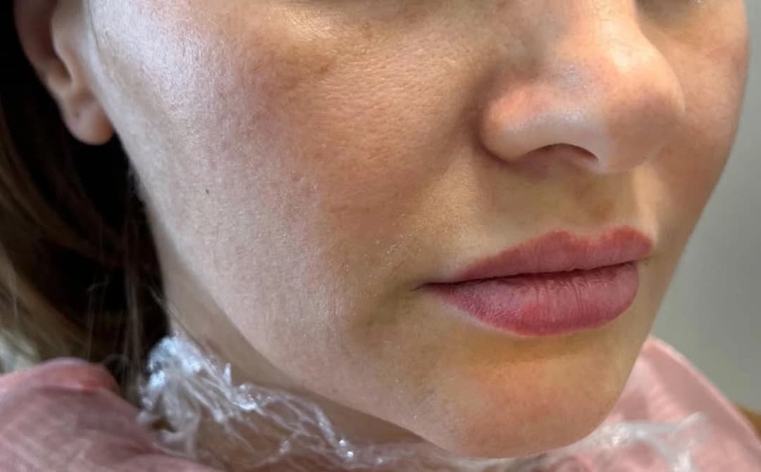 Before — T33™ Ultra Cold Jet Plasma