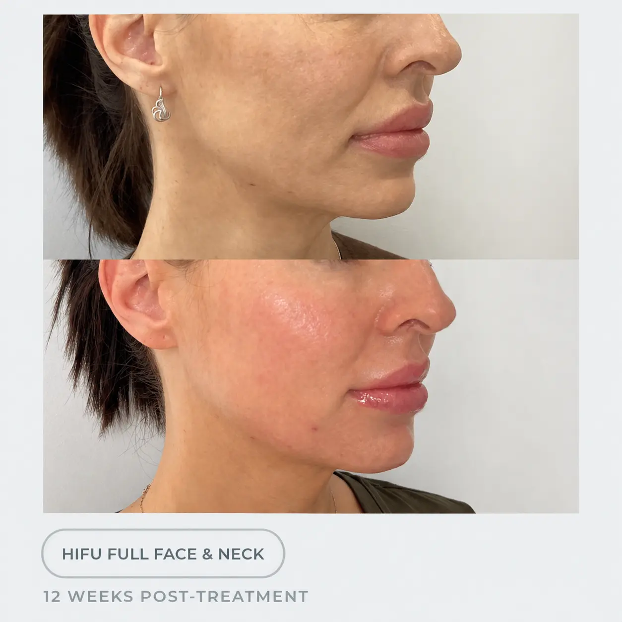 Cosmo Medispa result