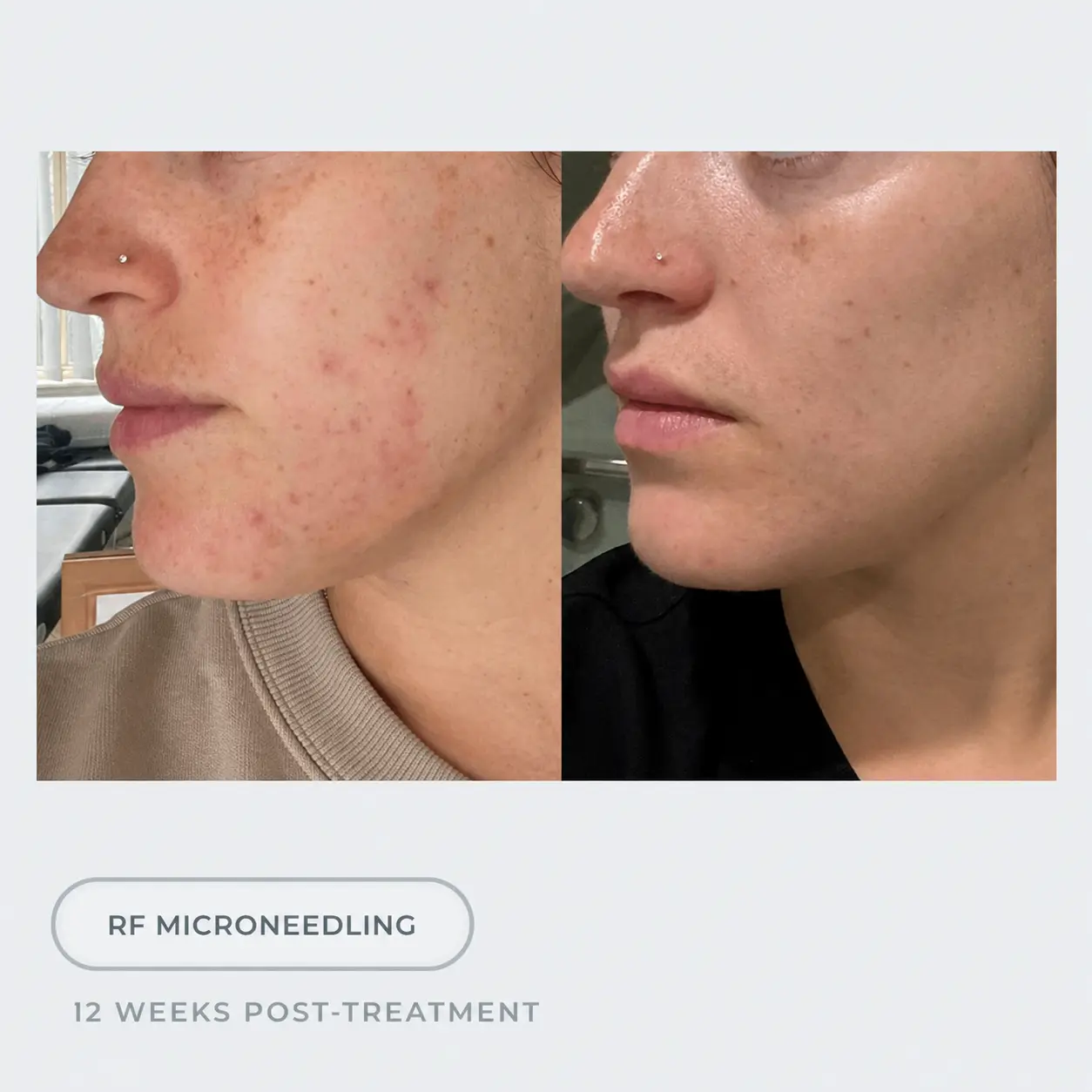 Cosmo Medispa result