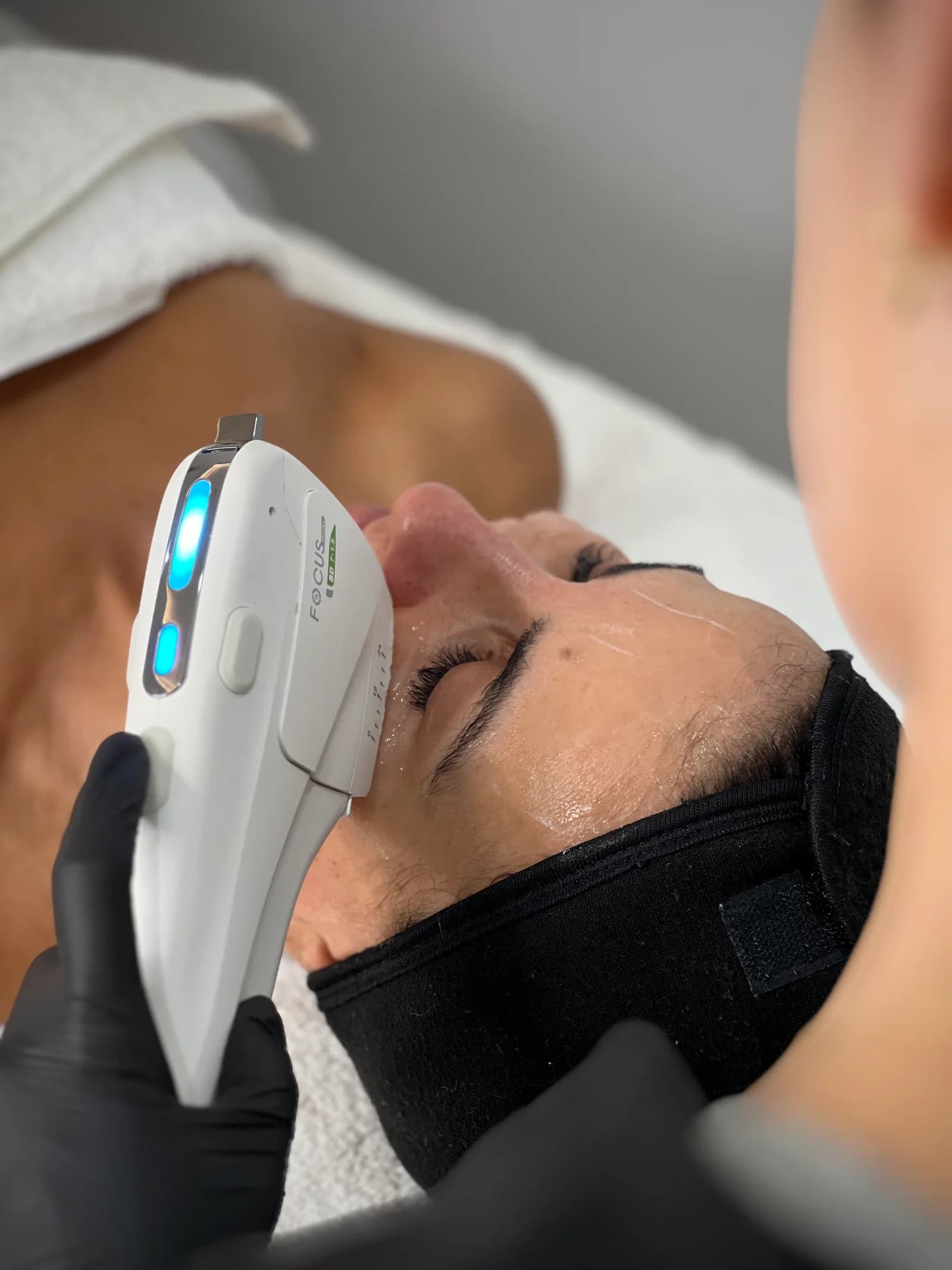 HIFU Treatment Results